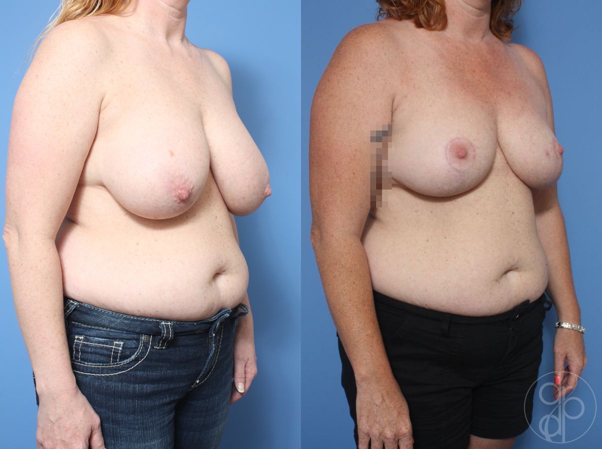 Before and after Breast Reduction case 29858 - Angle 3