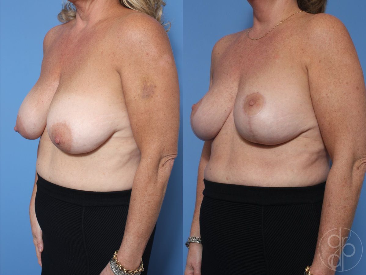 Before and after Breast Reduction case 29854 - Angle 2