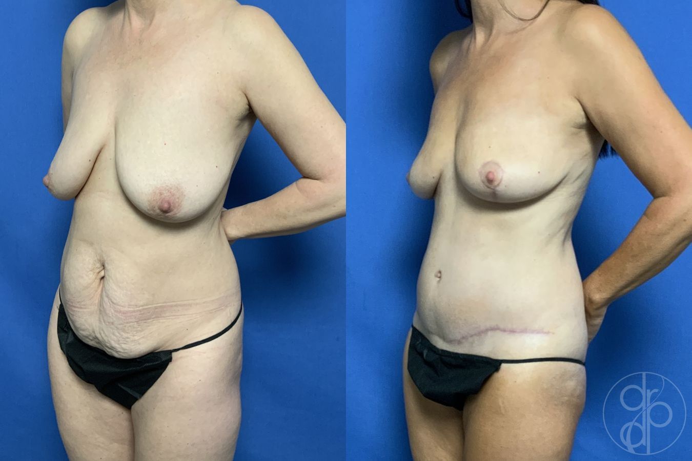 Before and after Mommy Makeover case 29714 - Angle 3