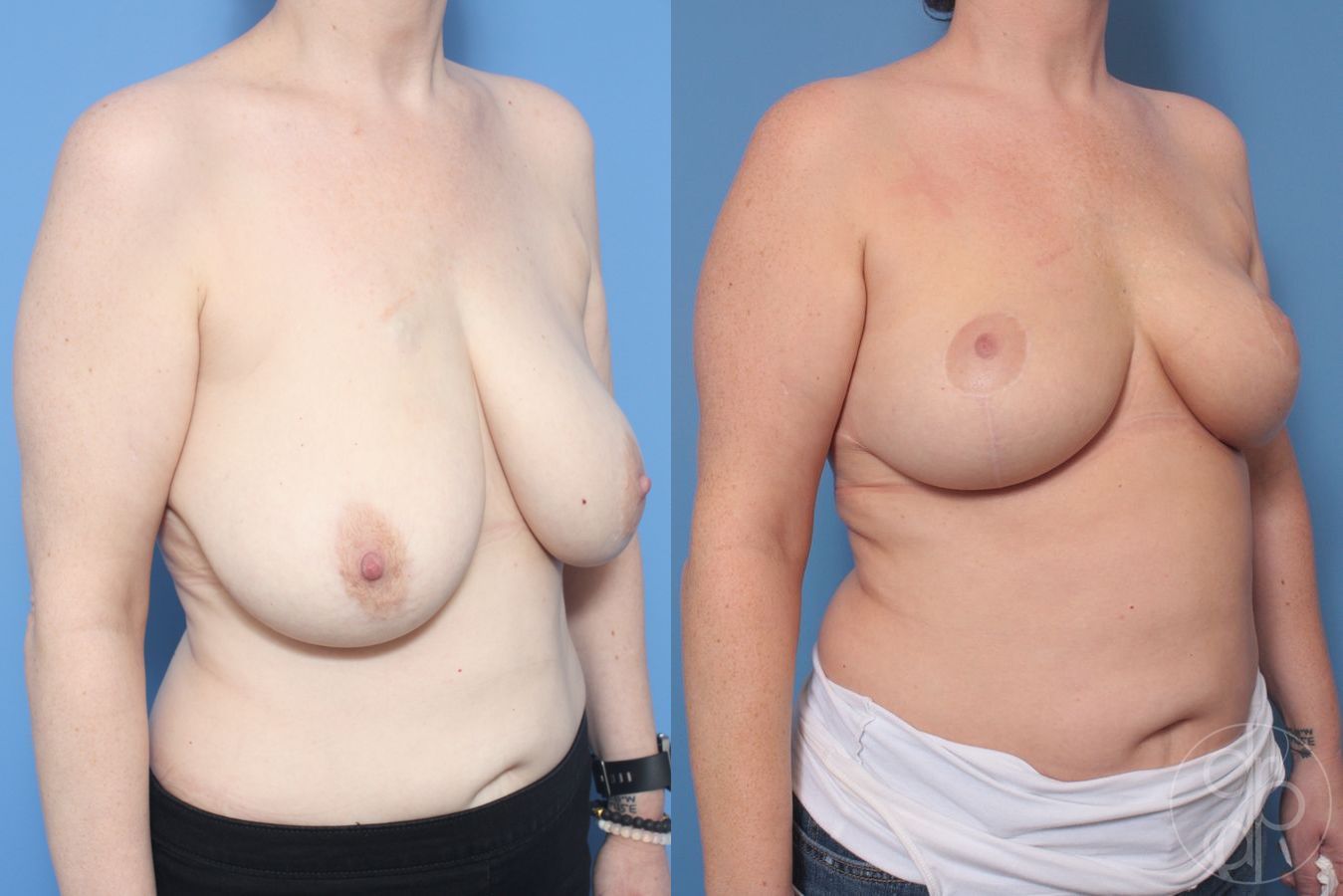 Before and after Breast Reduction case 29871 - Angle 3