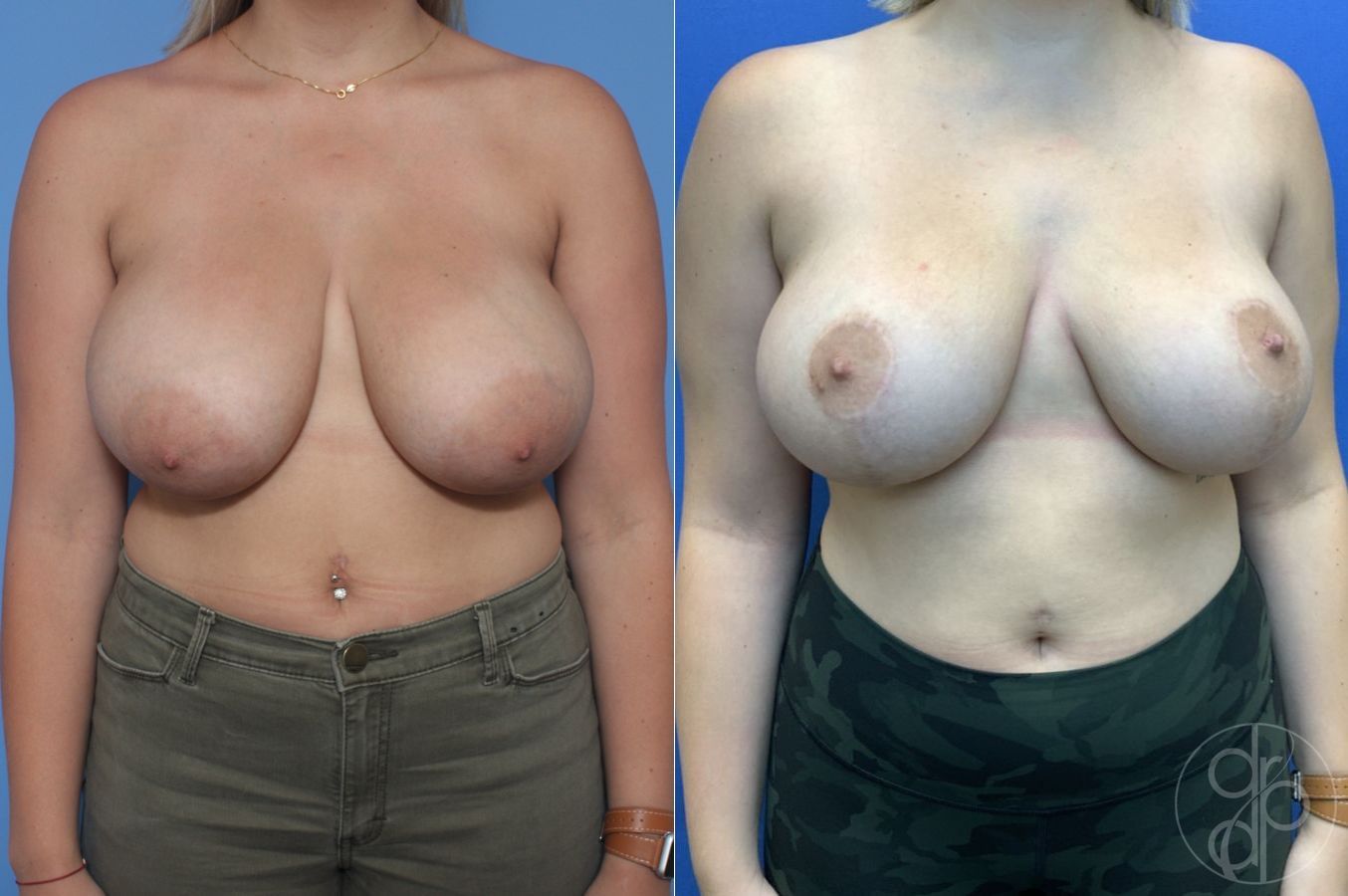 Before and after Breast Reduction case 29856