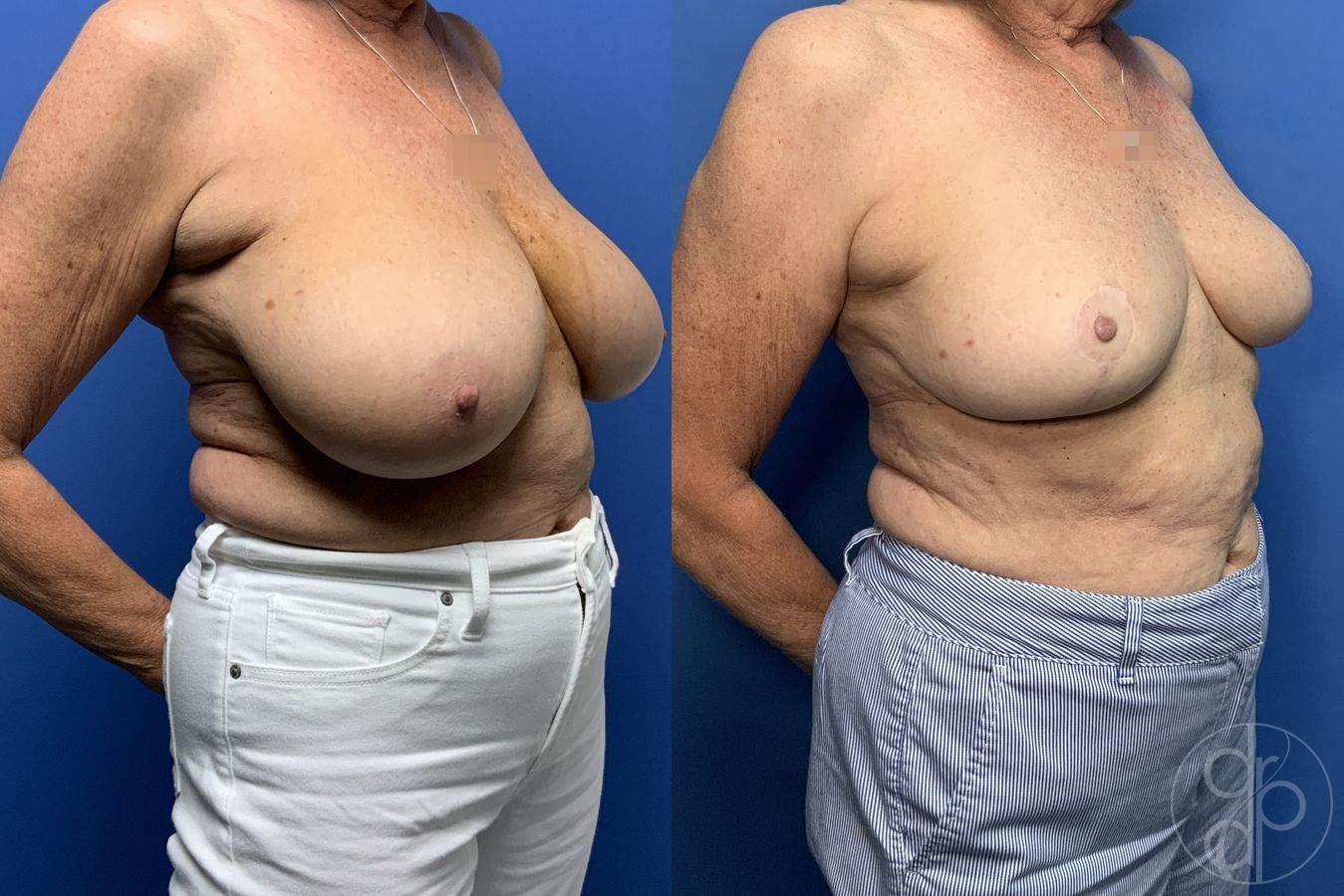 Before and after Breast Reduction case 29883 - Angle 2