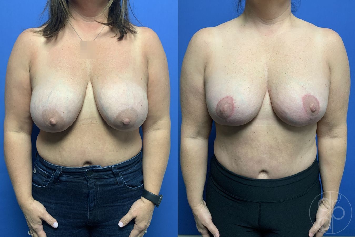 Before and after Breast Reduction case 29901