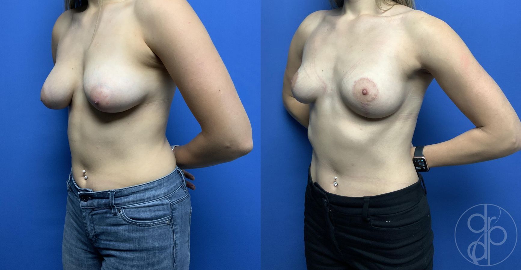 Before and after Breast Reduction case 29785 - Angle 3