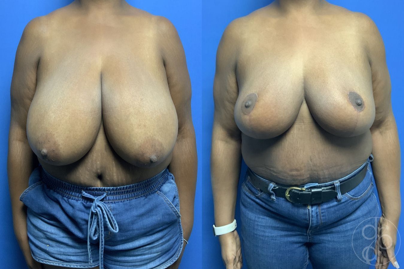Before and after Breast Reduction case 29879