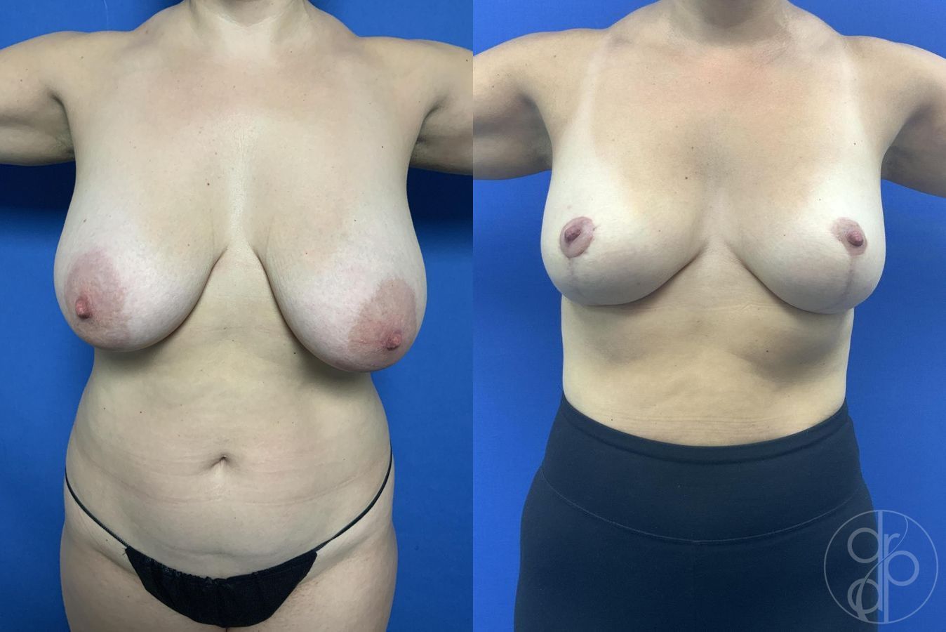 Before and after Breast Reduction case 29968 - Angle 2