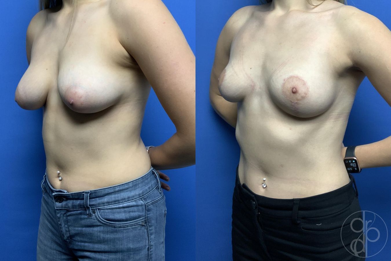 Before and after Breast Reduction case 29785 - Angle 3