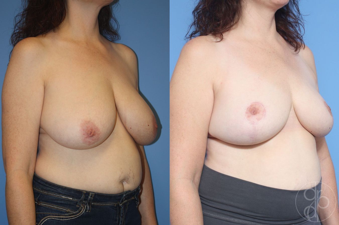 Before and after Breast Reduction case 29860 - Angle 2