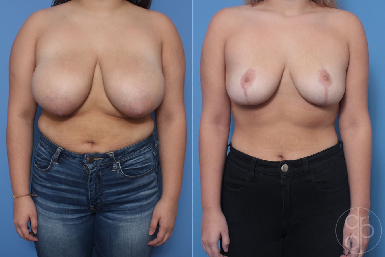 Before and after Breast Reduction case 29847