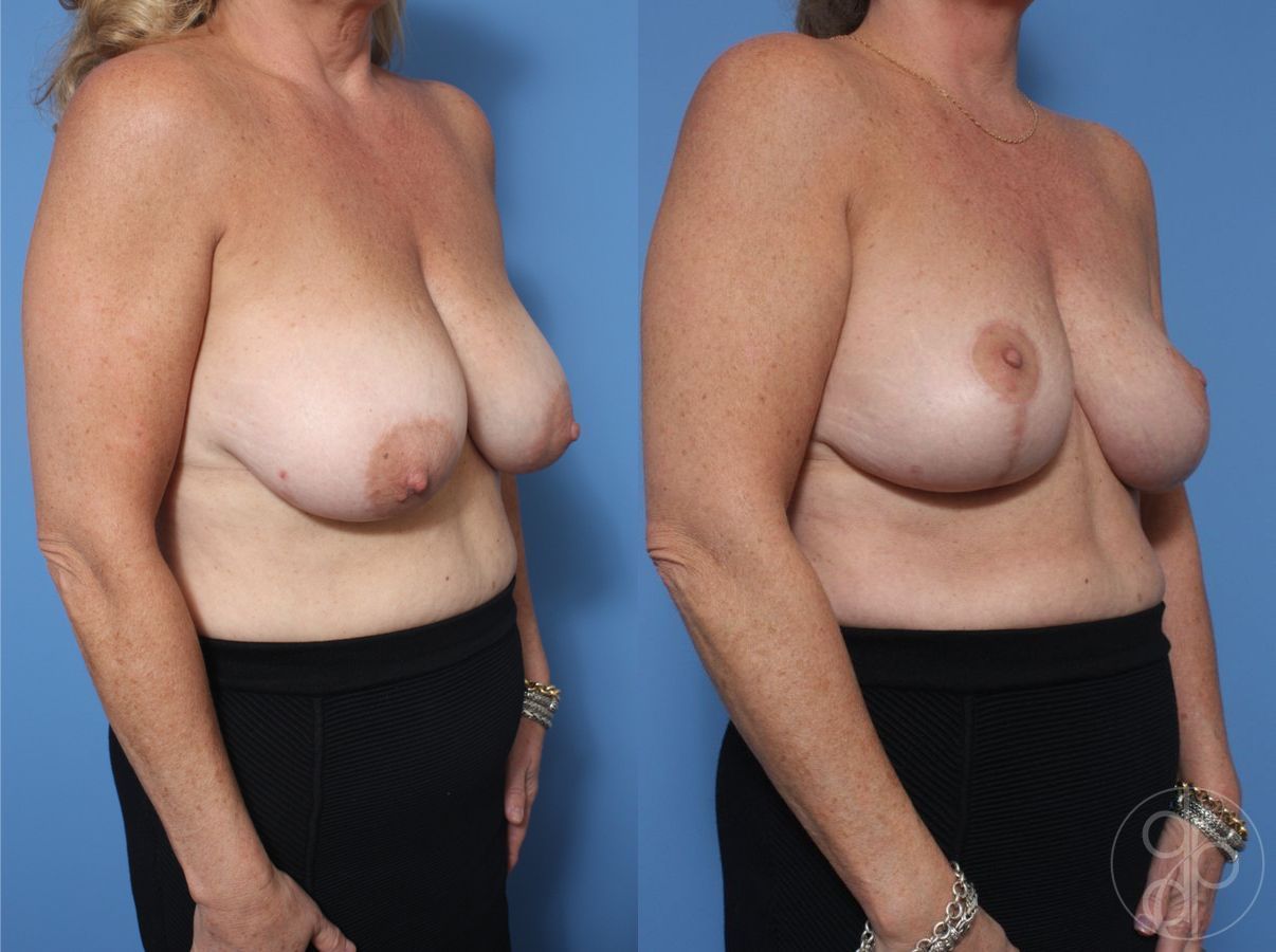 Before and after Breast Reduction case 29854 - Angle 3