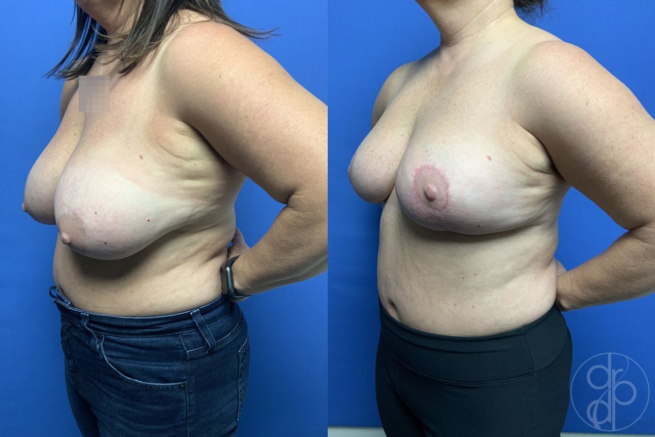 Before and after Breast Reduction case 29901 - Angle 3