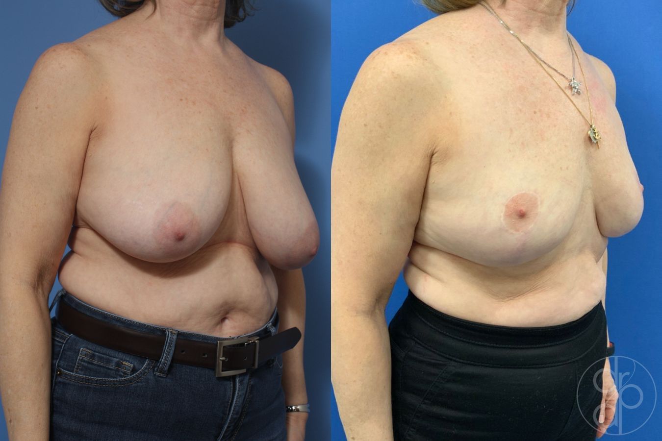 Before and after Breast Reduction case 29845 - Angle 2