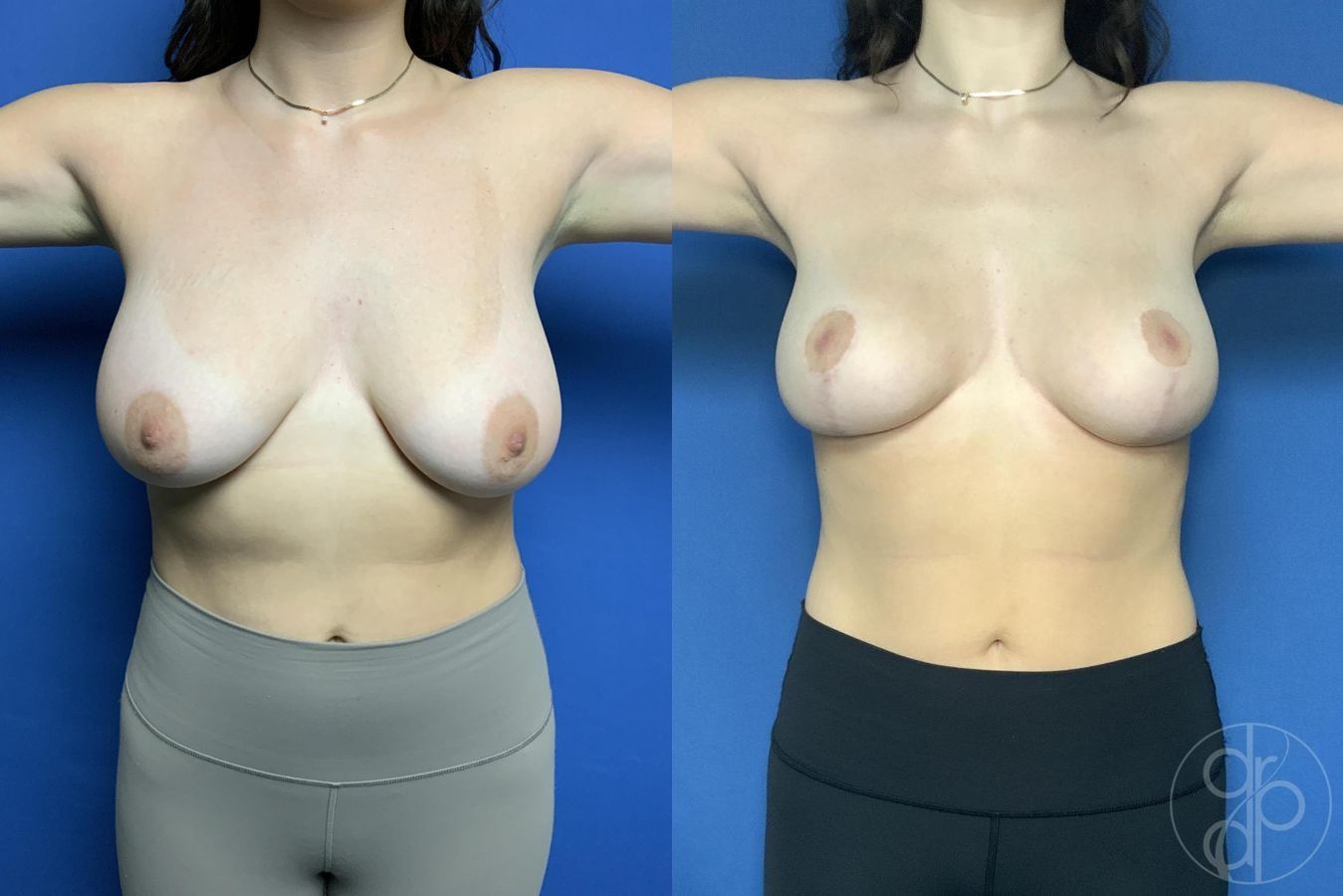 Breast Reduction - Thumbnail 2