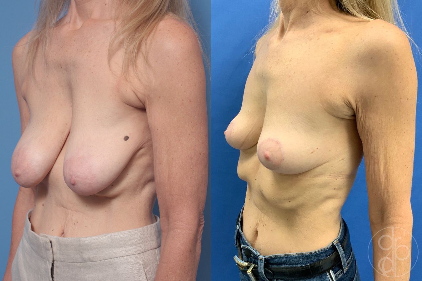 Before and after Breast Reduction case 29876 - Angle 2