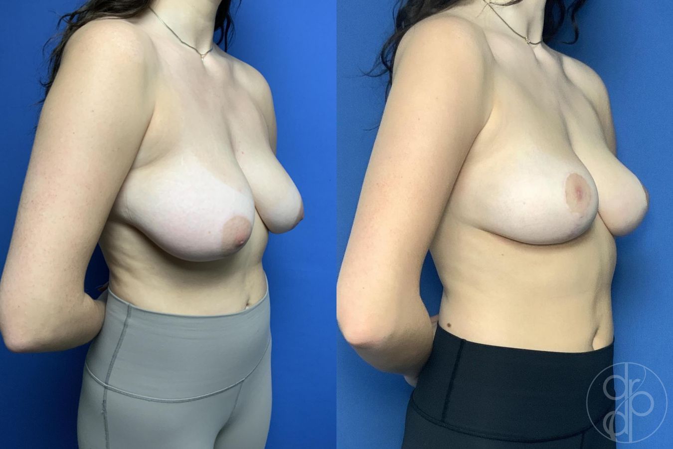 Breast Reduction - Thumbnail 3