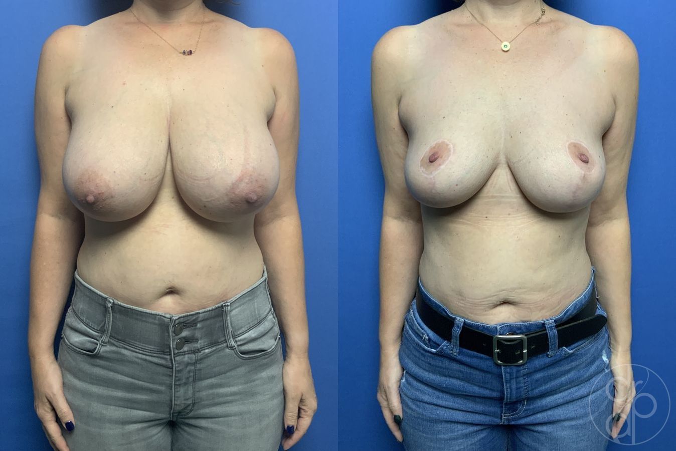 Before and after Breast Reduction case 29607