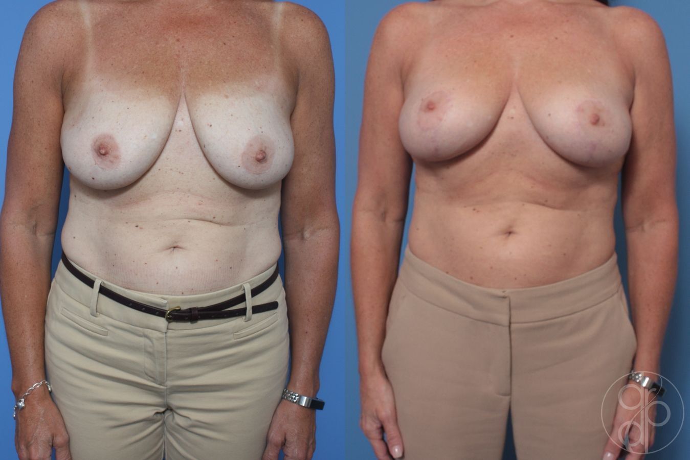 Before and after Breast Reduction case 29849