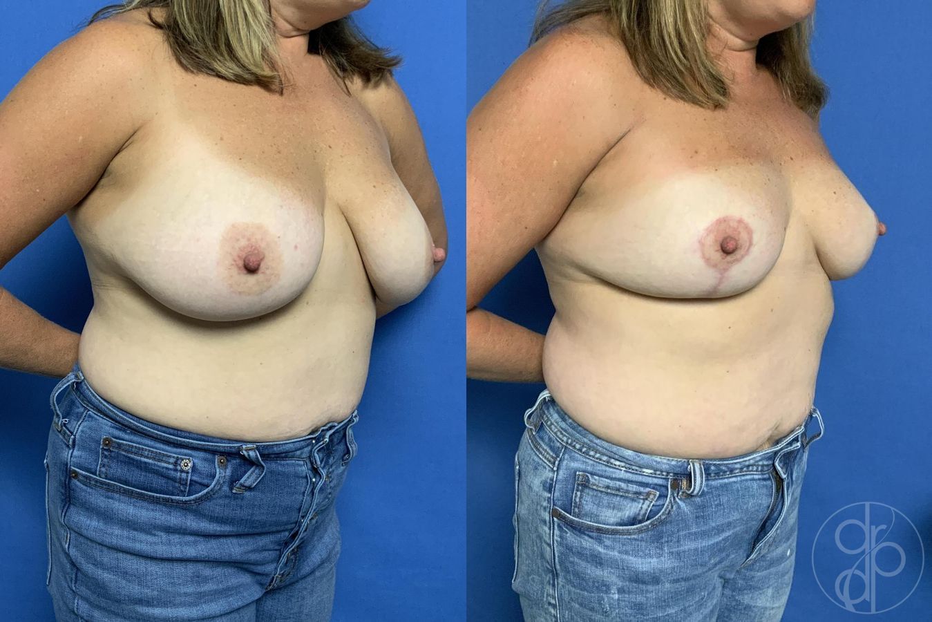 Before and after Breast Reduction case 29631 - Angle 3