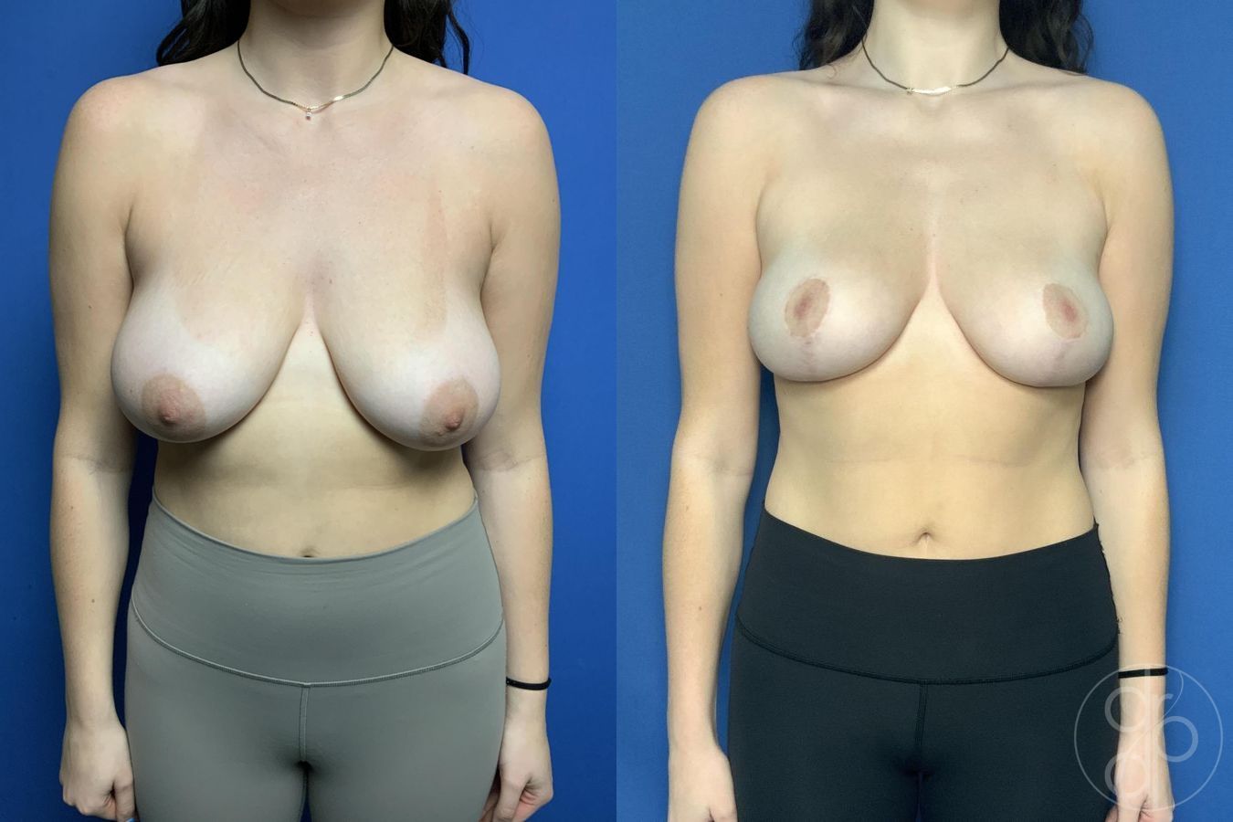 Breast Reduction - Case 505