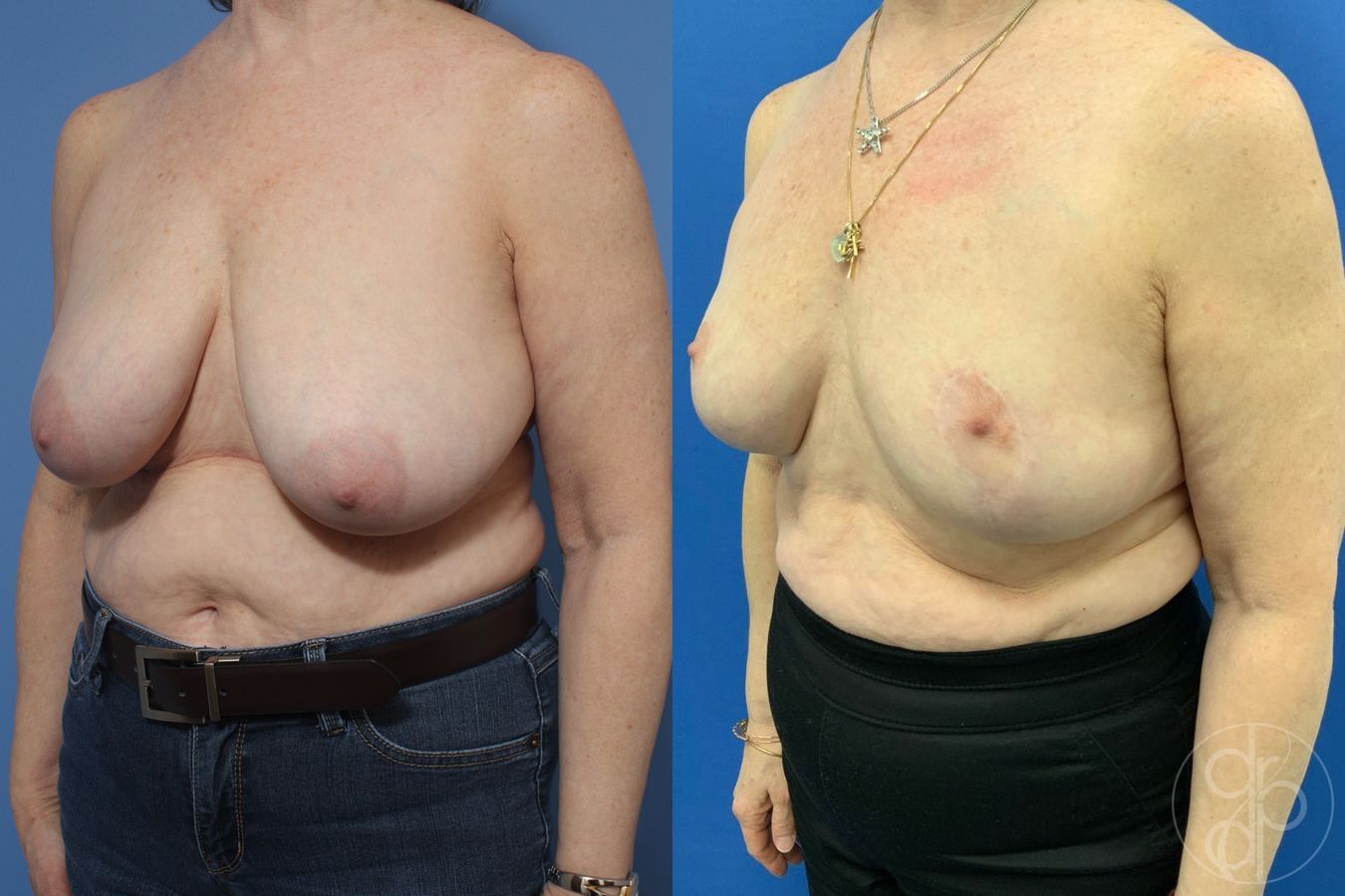 Before and after Breast Reduction case 29845 - Angle 3