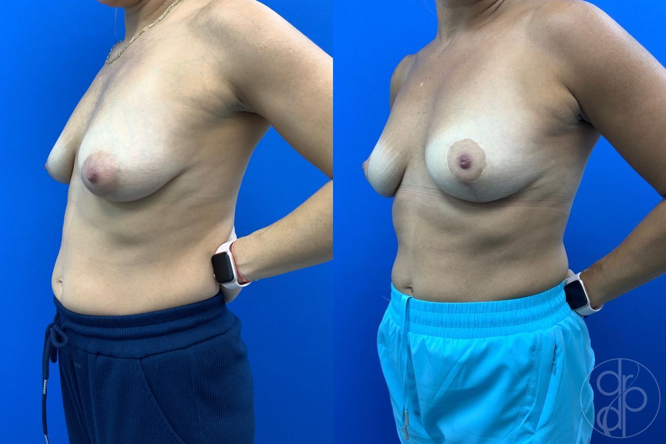 Before and after Breast Reduction case 43459 - Angle 3