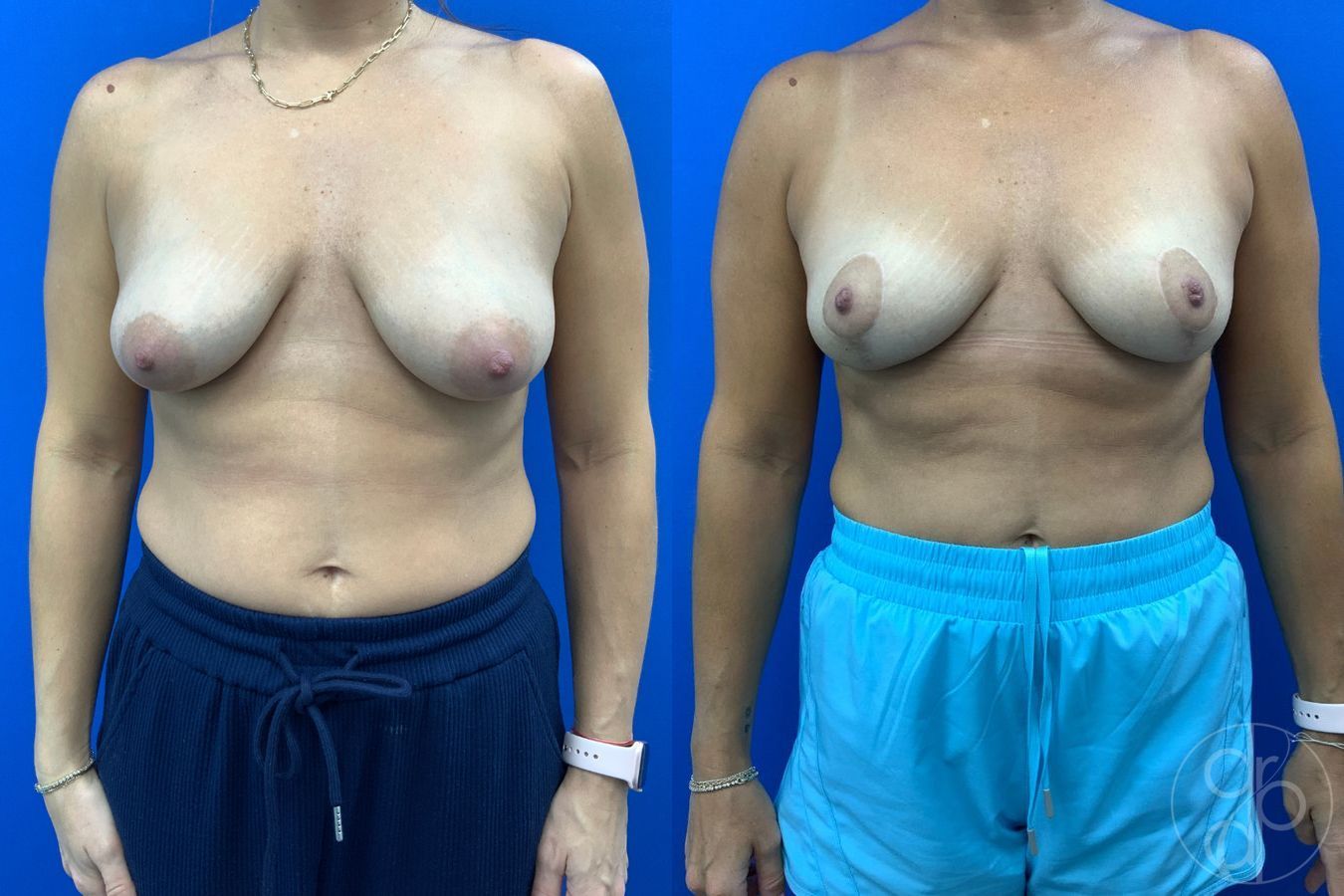 Before and after Breast Reduction case 43459