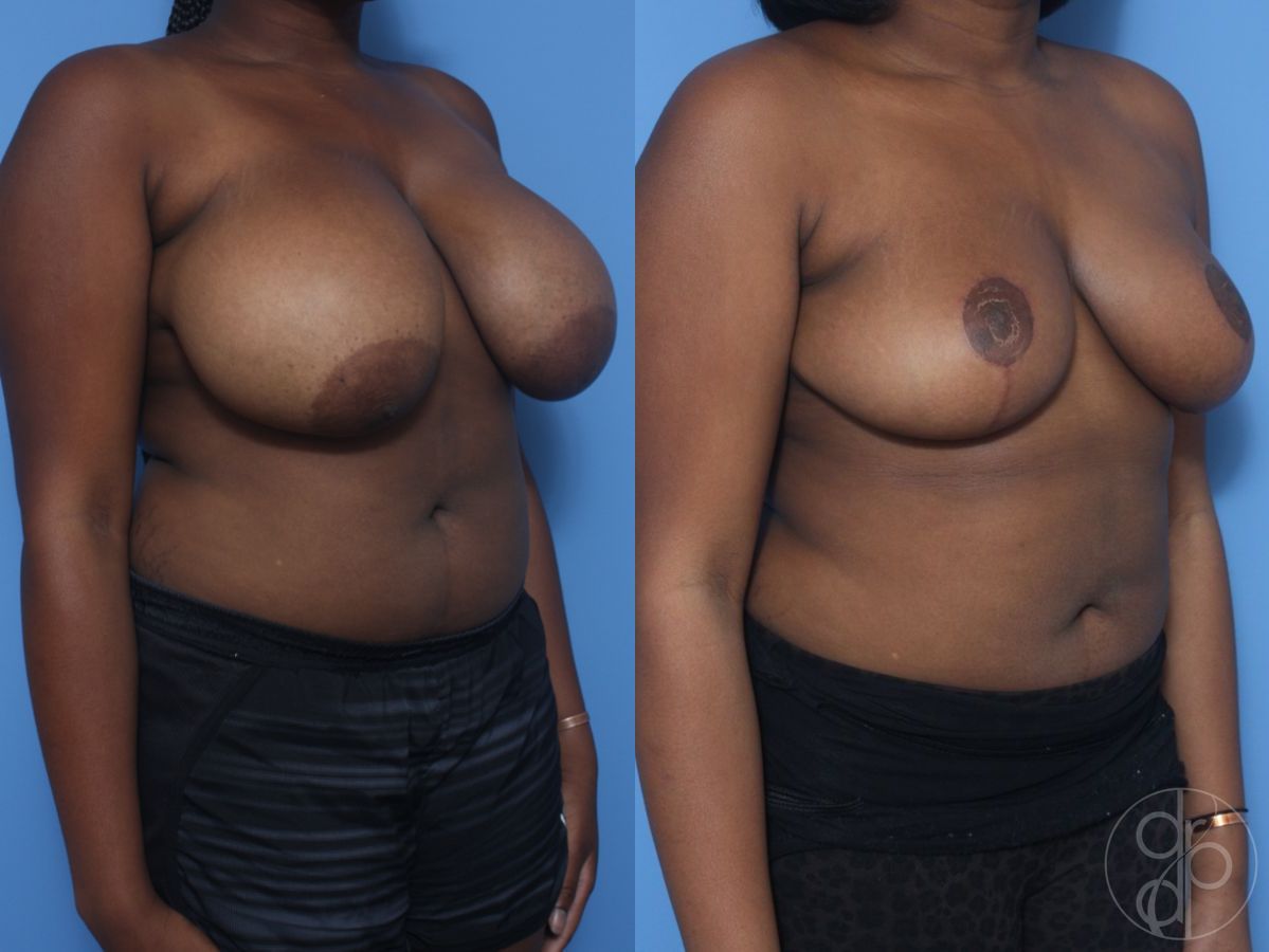Before and after Breast Reduction case 29850 - Angle 3