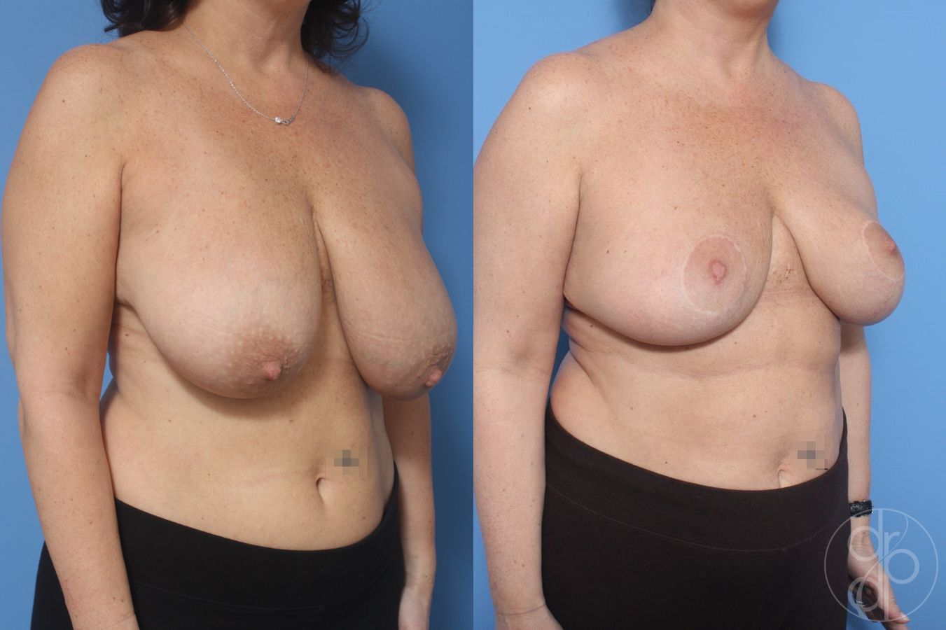 Before and after Breast Reduction case 29855 - Angle 3