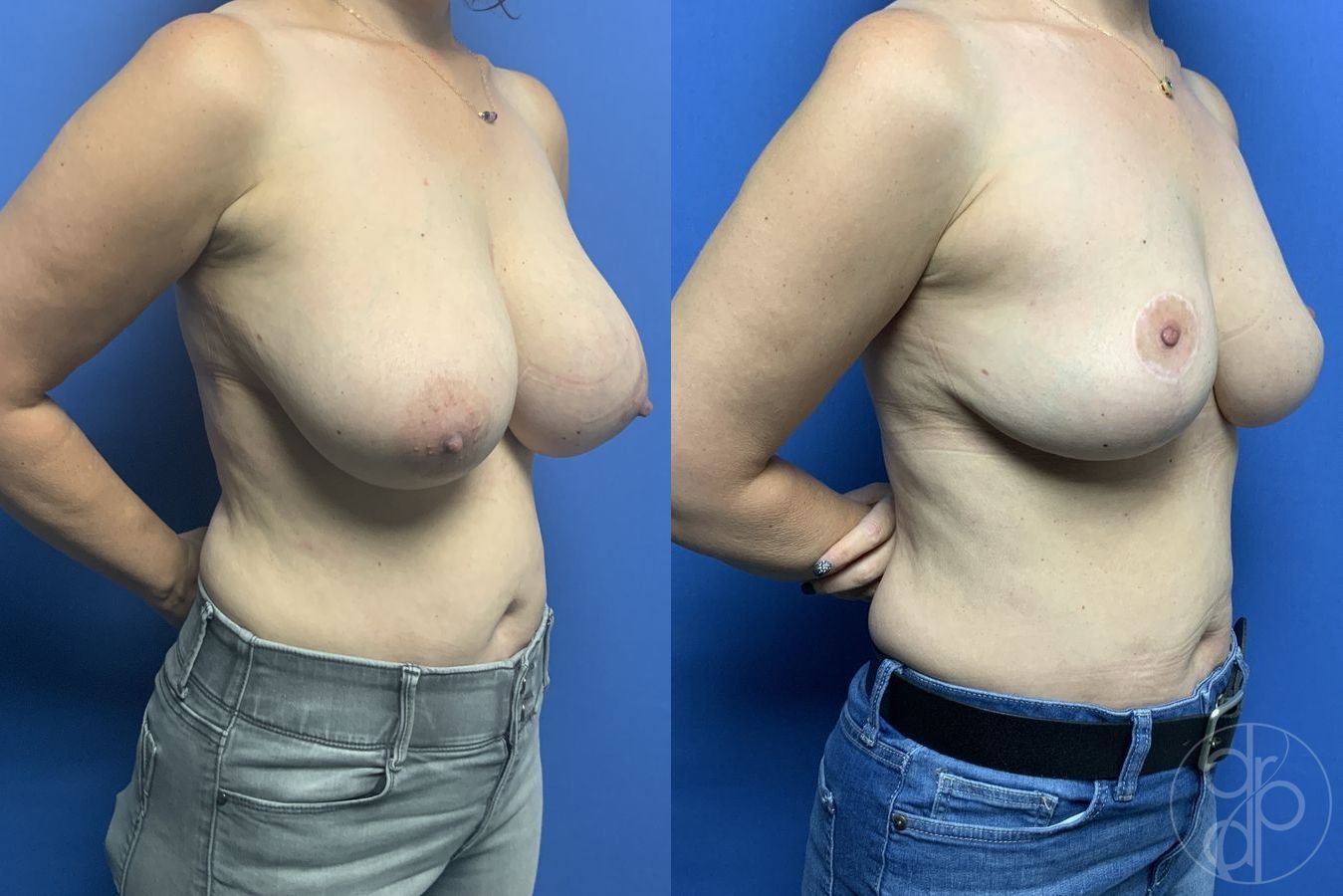 Before and after Breast Reduction case 29607 - Angle 2
