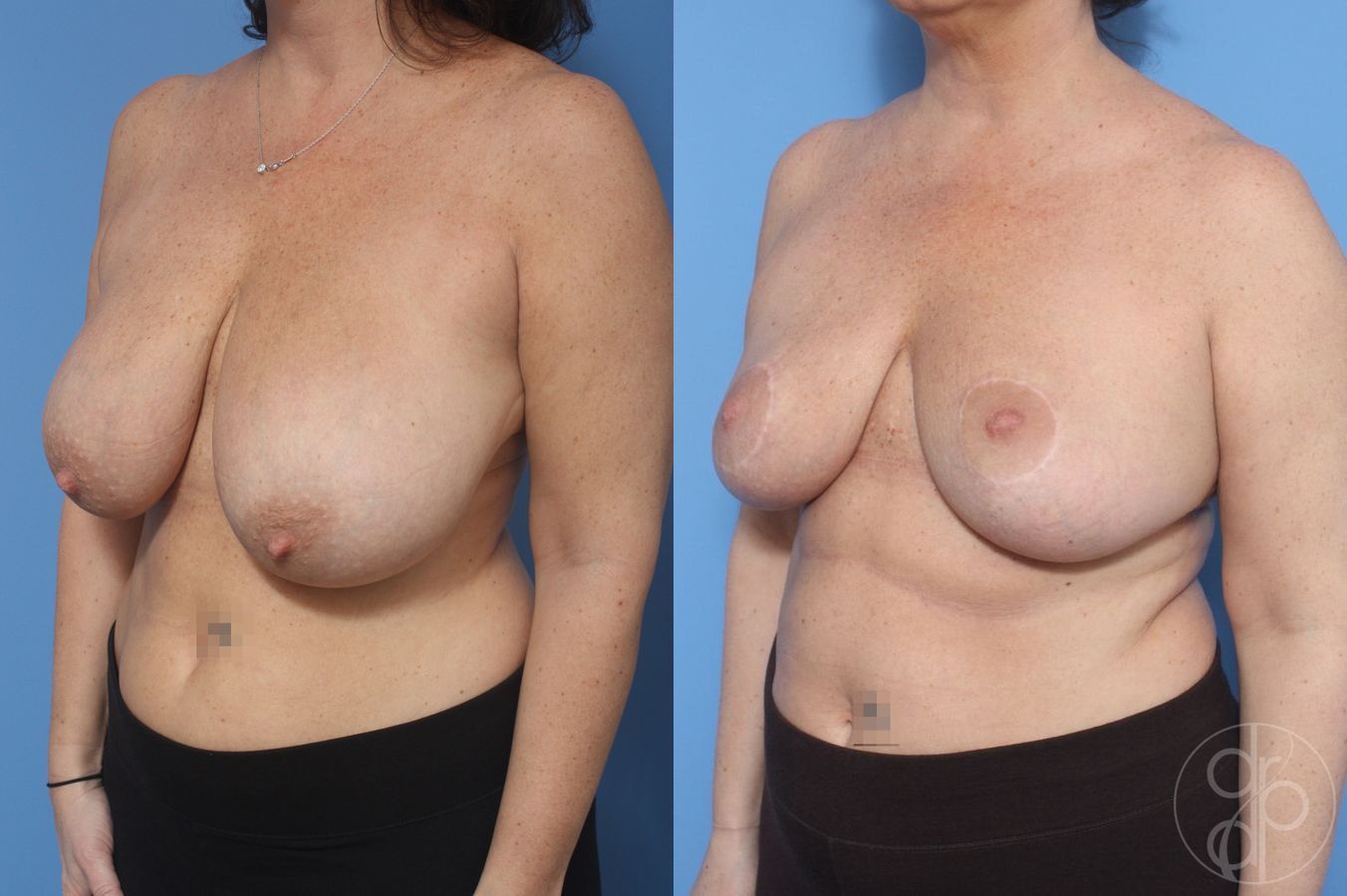 Before and after Breast Reduction case 29855 - Angle 2