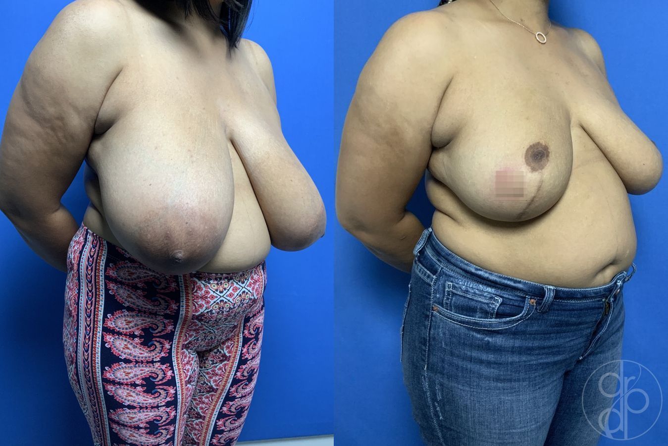 Breast Reduction - Thumbnail 3
