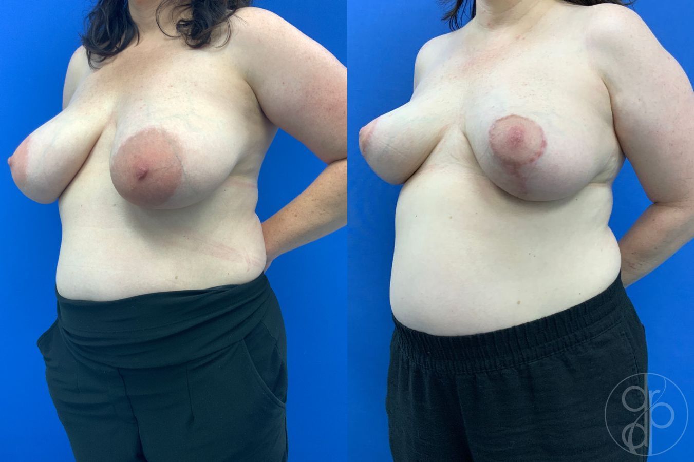 Before and after Tubular Breast Surgery case 46343 - Angle 3