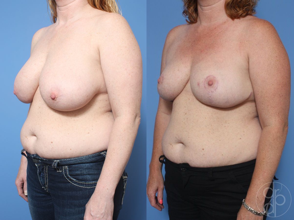 Before and after Breast Reduction case 29858 - Angle 2