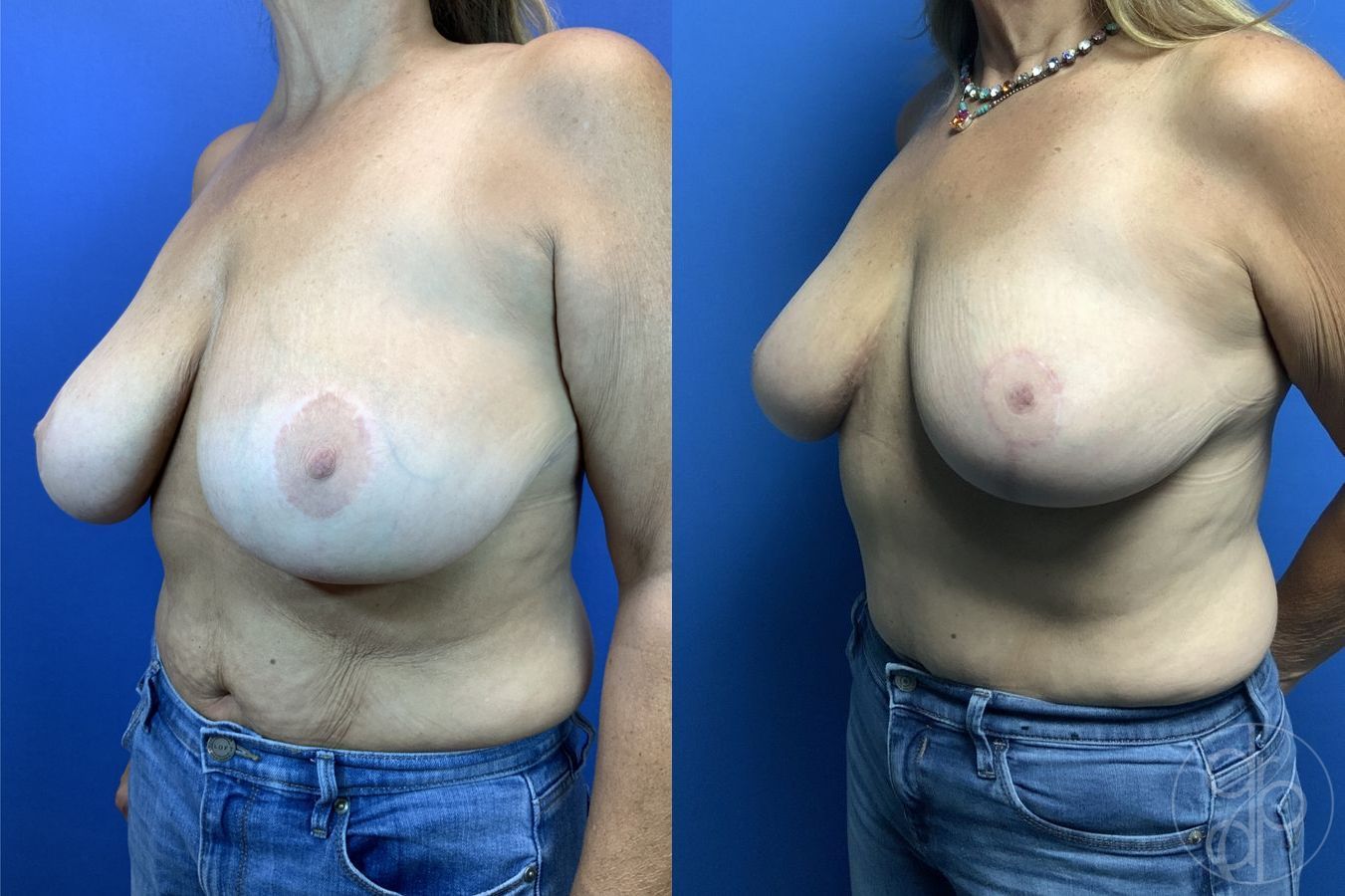 Before and after Breast Reduction case 29881 - Angle 2