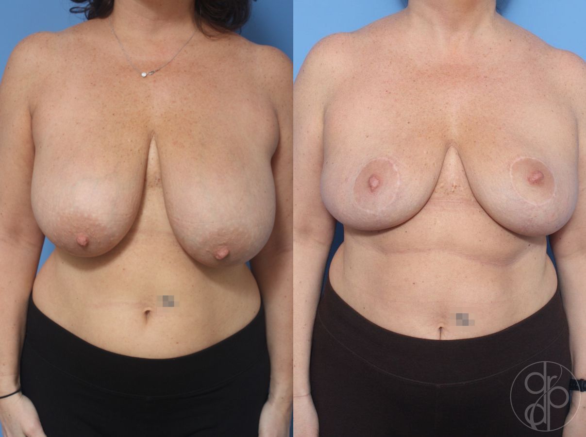 Before and after Breast Reduction case 29855