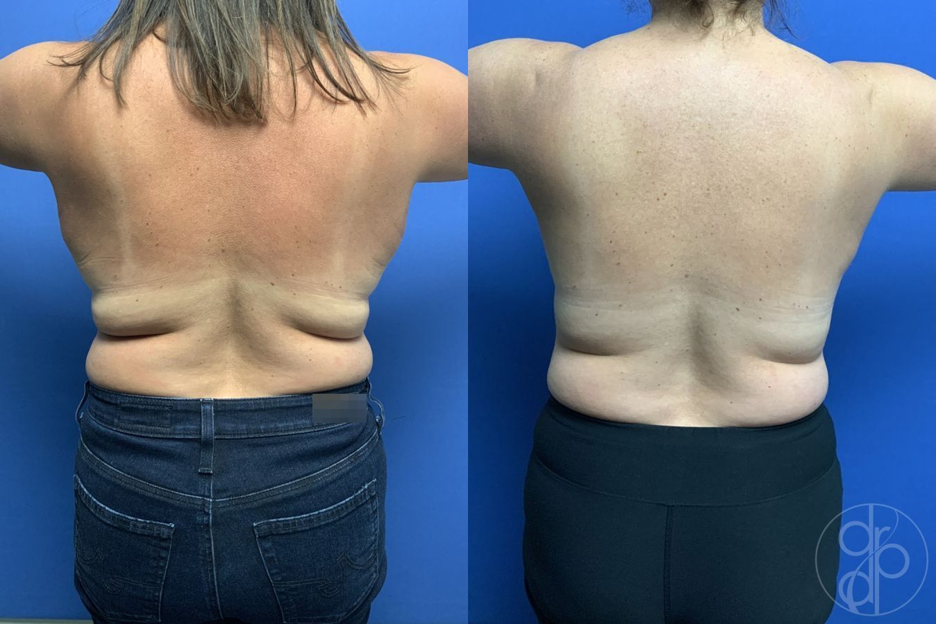 Before and after Breast Reduction case 29901 - Angle 4