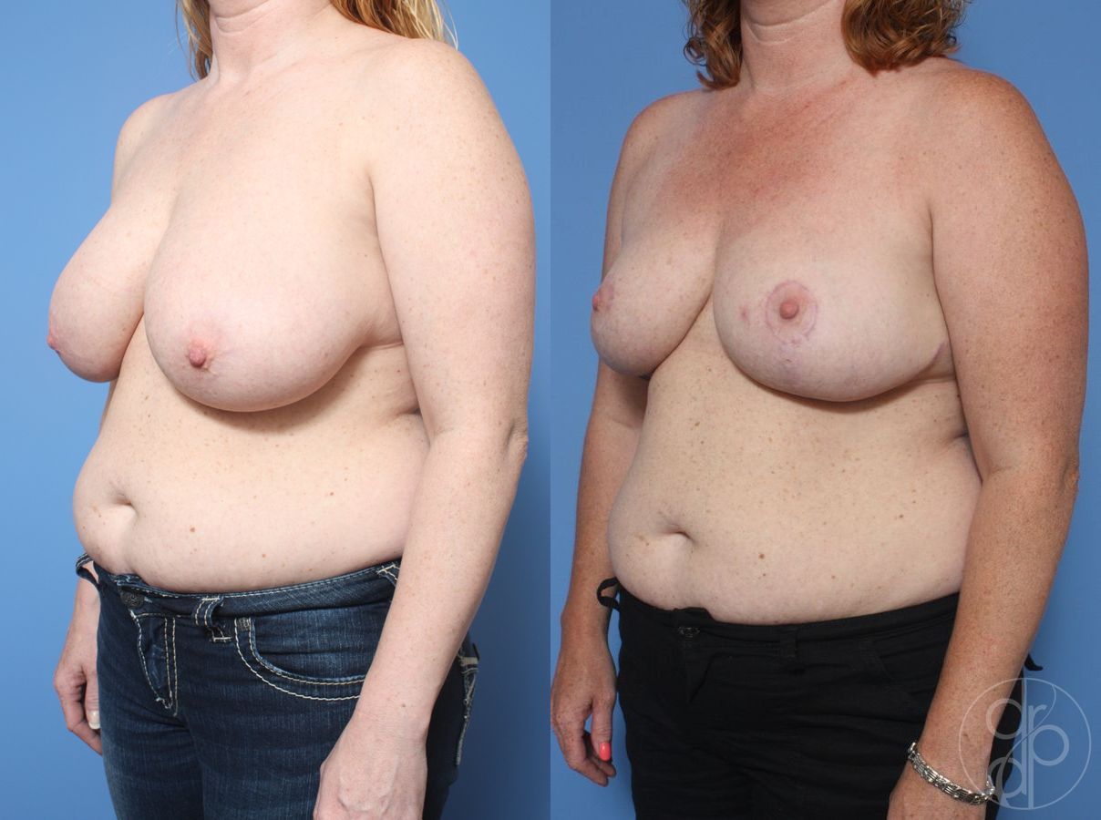 Before and after Breast Reduction case 29858 - Angle 2