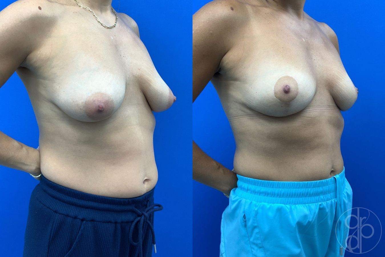 Before and after Breast Reduction case 43459 - Angle 4