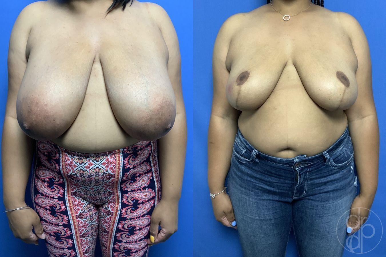 Breast Reduction - Case 519