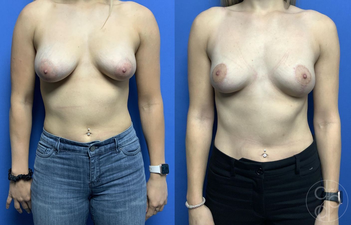 Before and after Breast Reduction case 29785