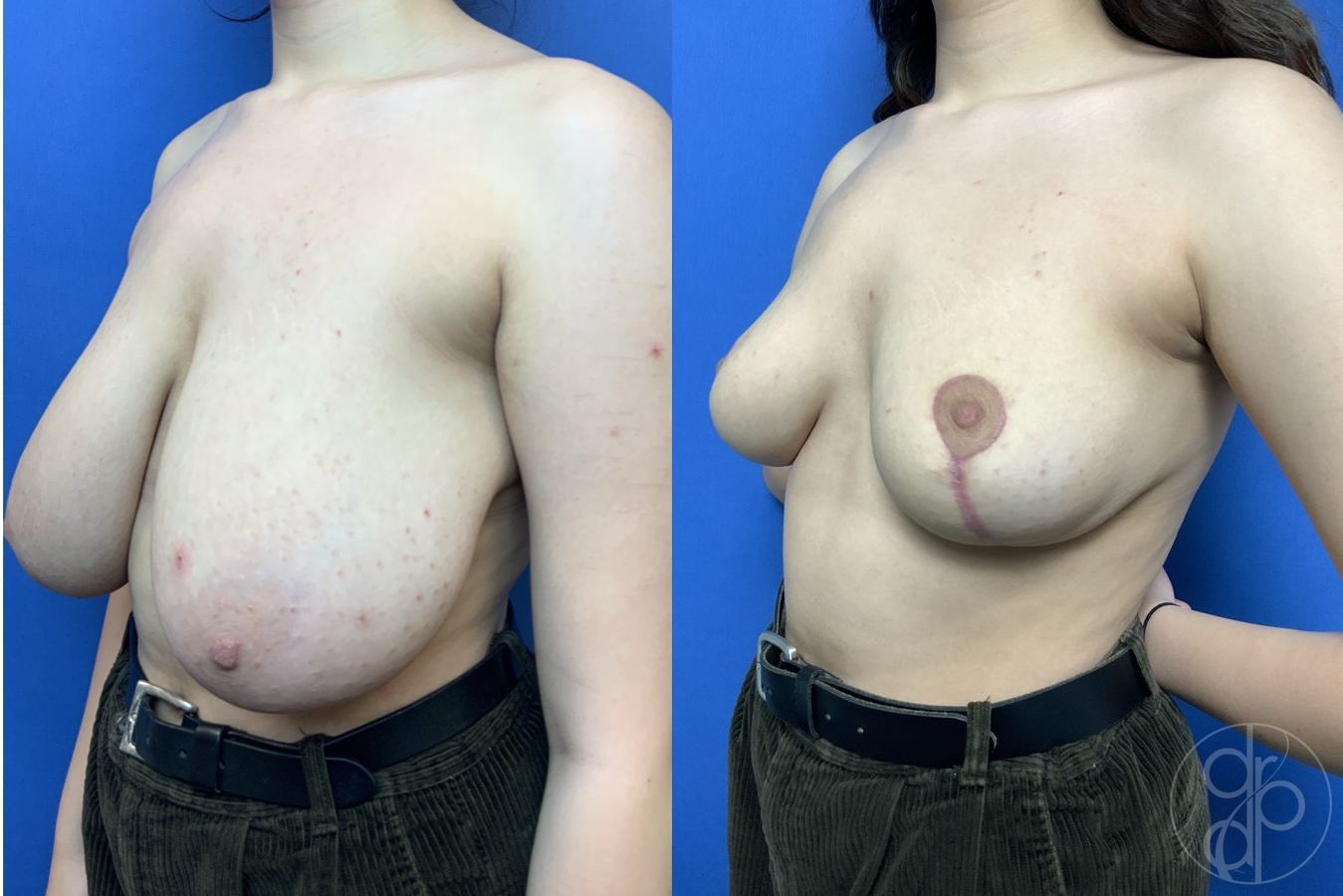 Before and after Breast Reduction case 29880 - Angle 2