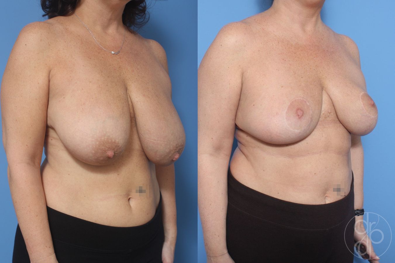 Before and after Breast Reduction case 29855 - Angle 3