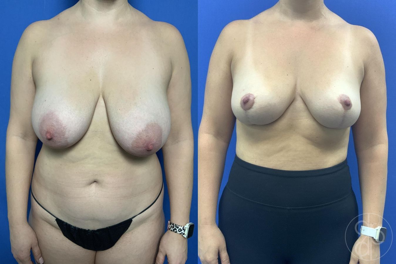 Before and after Breast Reduction case 29968