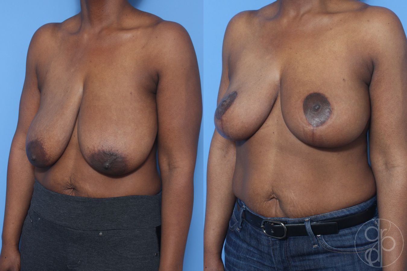 Before and after Breast Reduction case 29853 - Angle 3