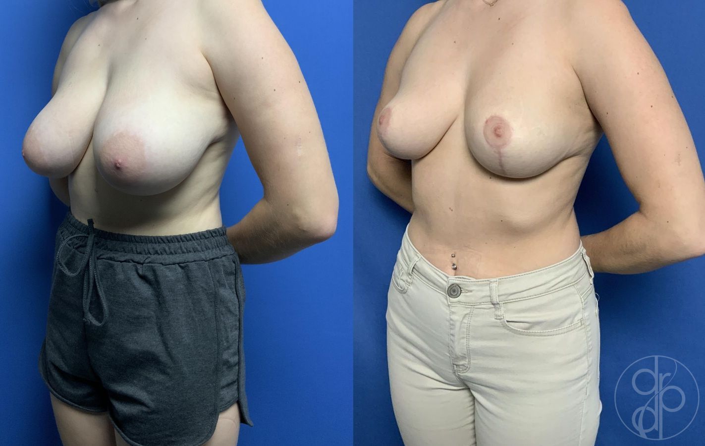 Before and after Breast Reduction case 29784 - Angle 2
