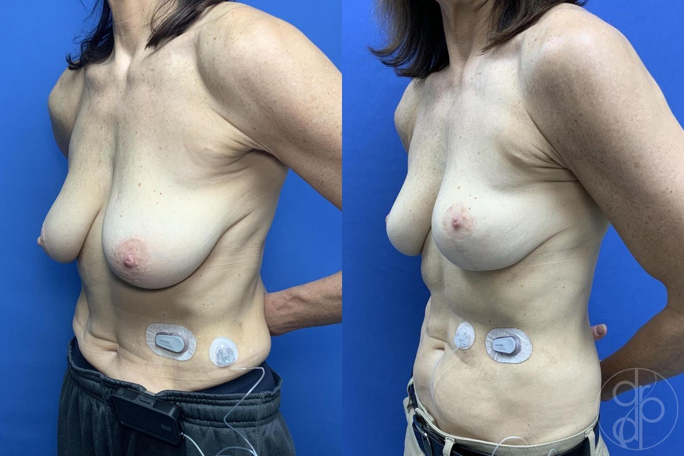 Before and after Breast Reduction case 29646 - Angle 3