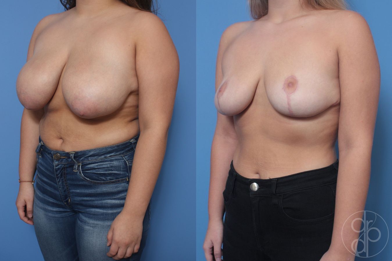 Before and after Breast Reduction case 29847 - Angle 3