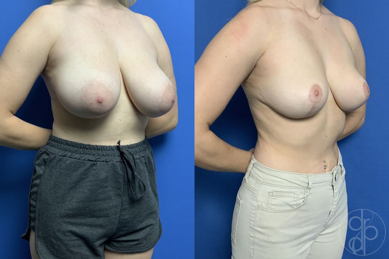 Before and after Breast Reduction case 29784 - Angle 3