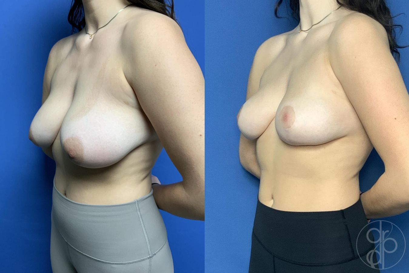 Breast Reduction - Thumbnail 4