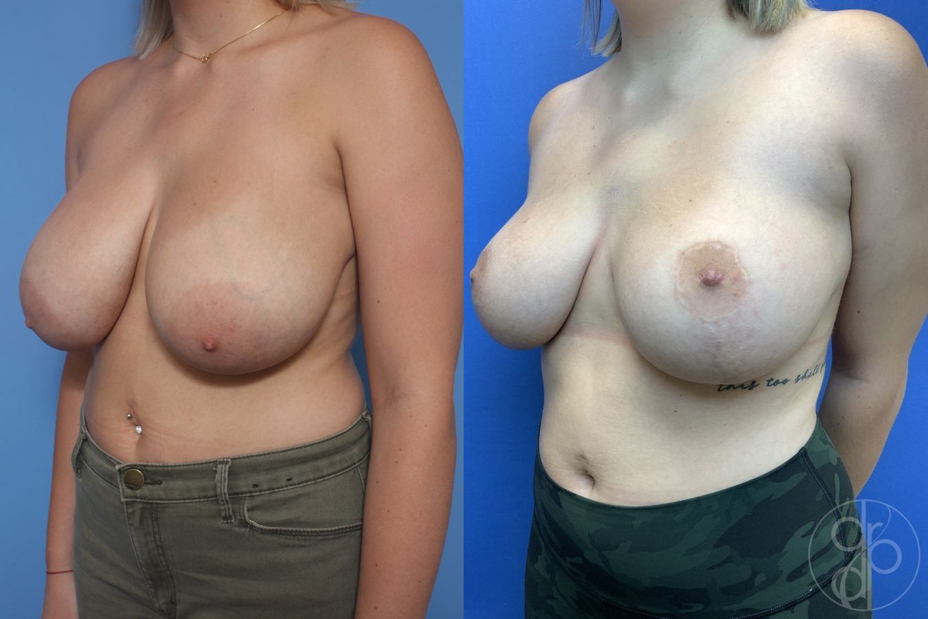 Before and after Breast Reduction case 29856 - Angle 3